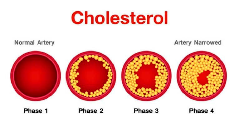Socola còn giúp giảm Cholesterol xấu (LDL) và cải thiện Cholesterol tốt (HDL)